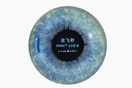 全飛秒近視眼手術后多久能打球 全飛秒近視眼手術后多久能打球